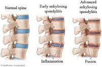 ankylosing spondylitis, ankylosing spondylitis video